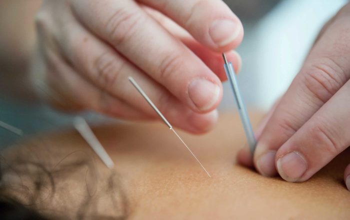 Image of acupuncture needles being inserted in someone's back