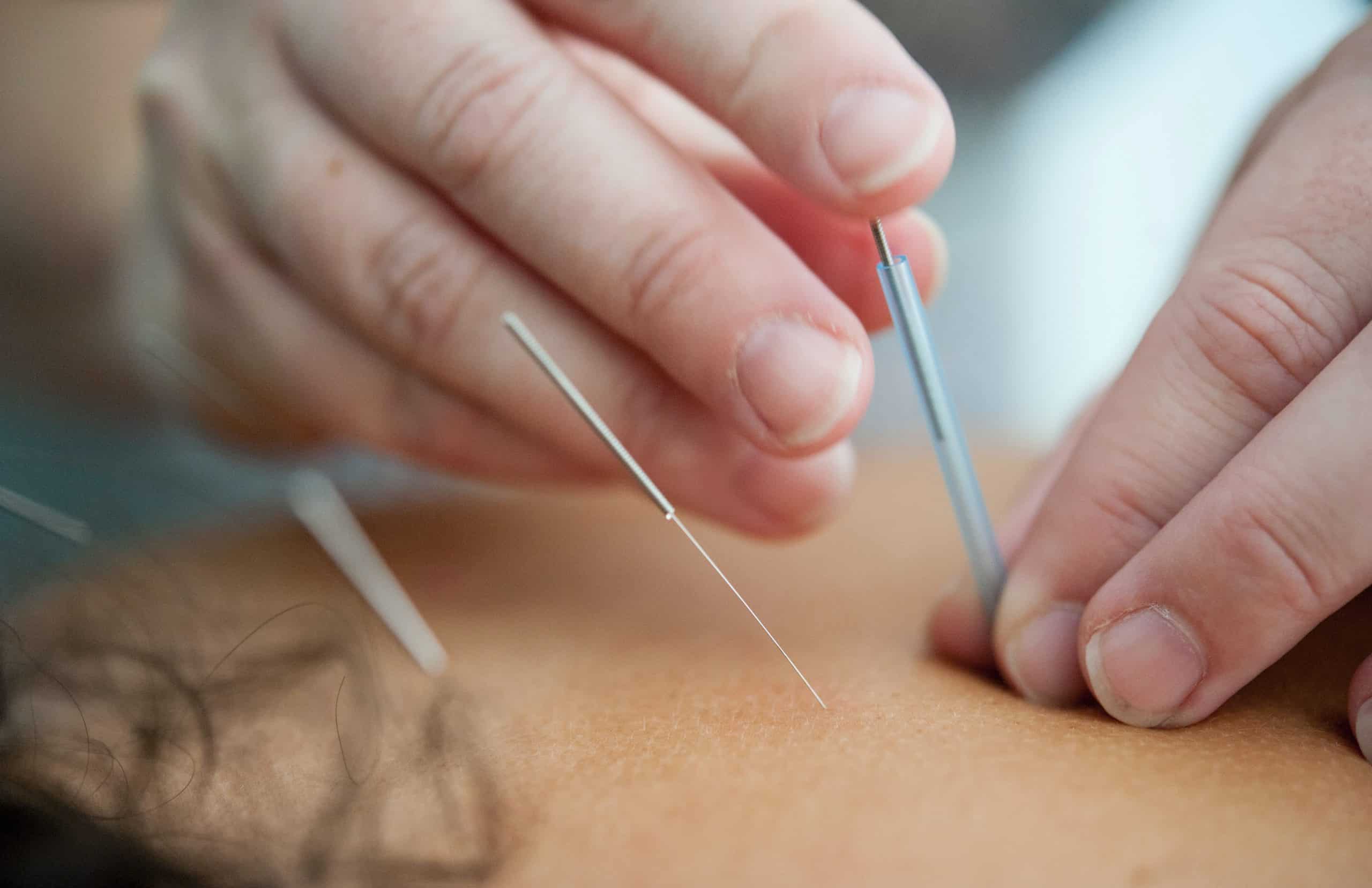 Image of acupuncture needles being inserted in someone's back